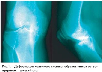 Medicus Amicus - Артрит коленного сустава