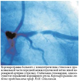 Коронарный синдром