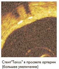 стент 'Taxus' в просвете артерии в большем увеличении