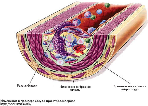 Вакцинация при атеросклерозе