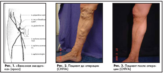 tablete în vene varicoase ale extremitailor inferioare)